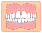 空隙歯列（くうげきしれつ）