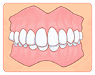 過蓋咬合（かがいこうごう）